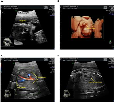 Case report: A novel compound heterozygous variant in the TNXB gene causes single kidney agenesis and vesicoureteral reflux
